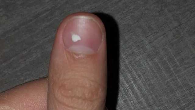 Manchas blancas en la uña del dedo pulgar de un hombre. (Foto: Wikimedia)